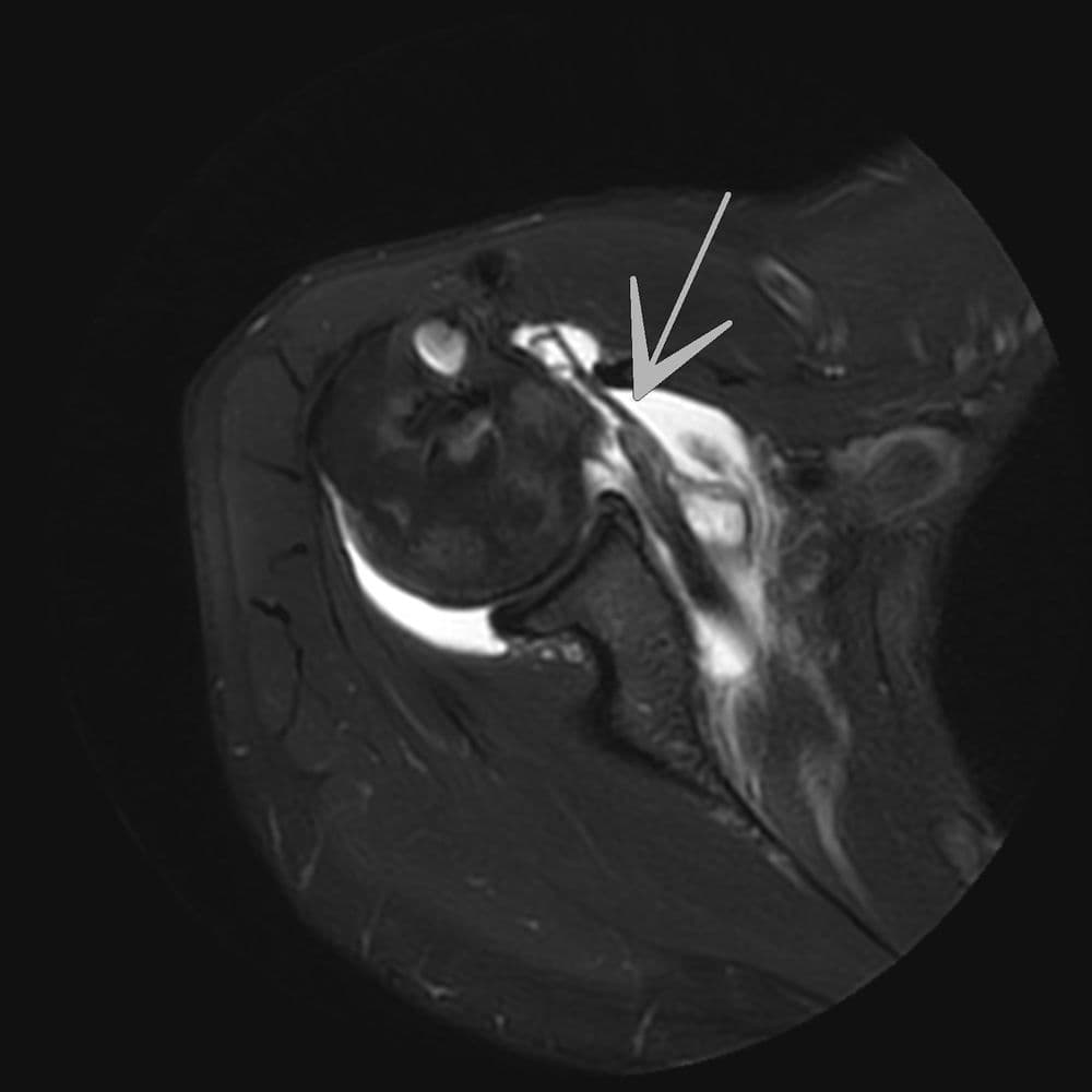 Rupture du tendon sous-scapulaire