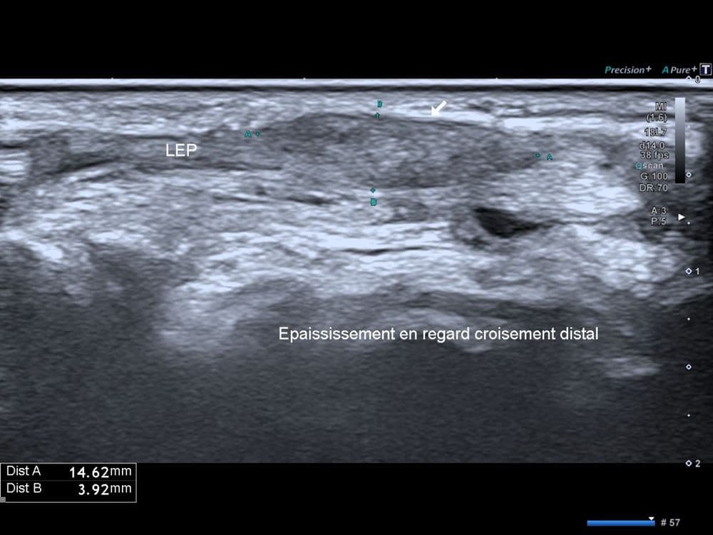 Syndrome du croisement distal au poignet