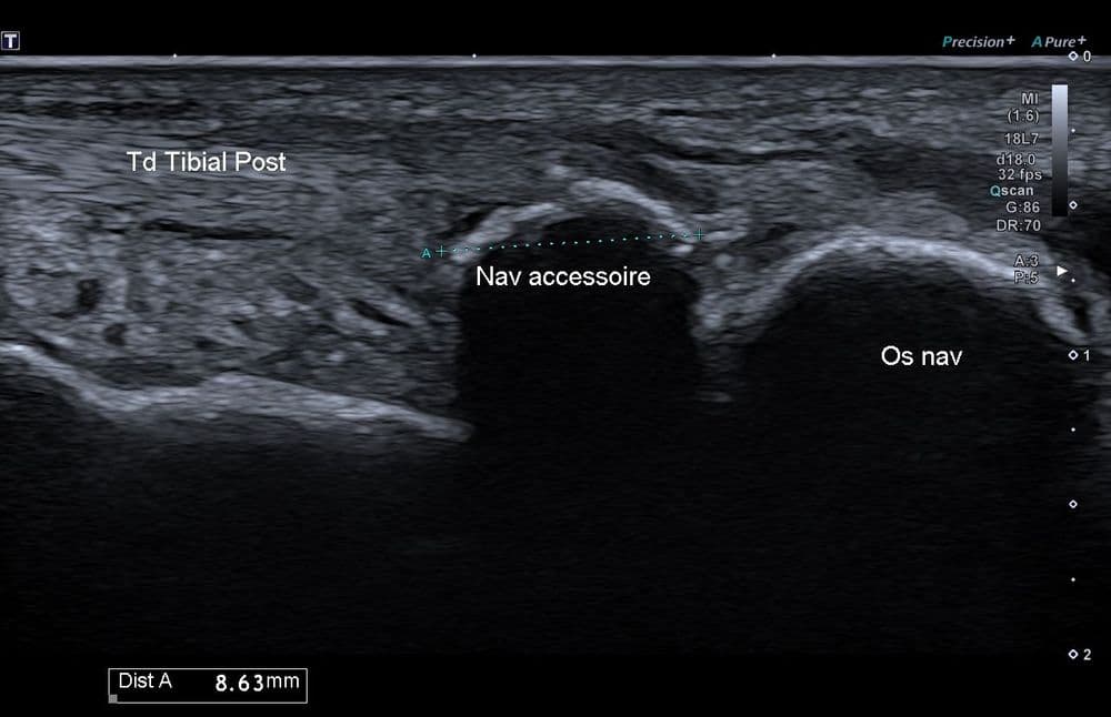 Enthésopathie du tendon tibial postérieur