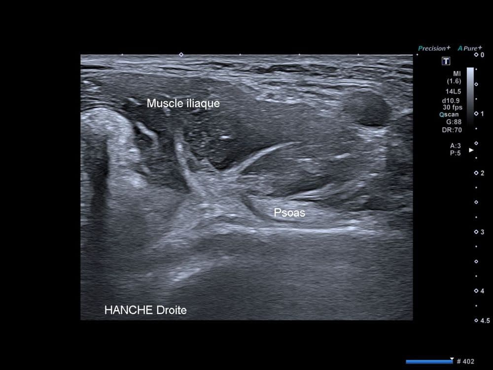 Ressaut antérieur de hanche