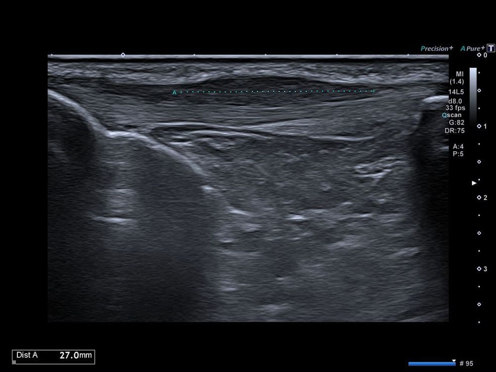 Tendinopathie patellaire corporéale superficielle