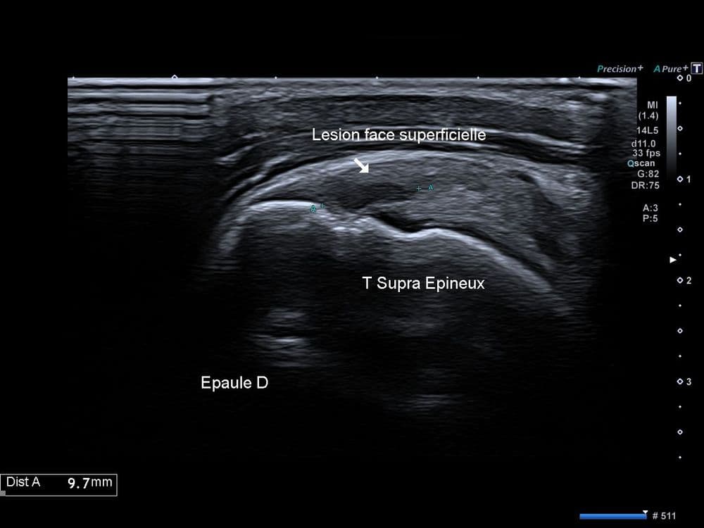 Rupture partielle du tendon supra épineux (face bursale)
