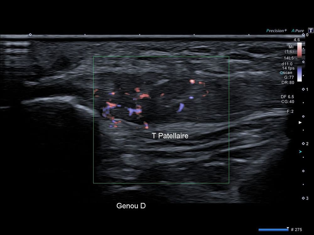Tendinopathie patellaire corporéale globale