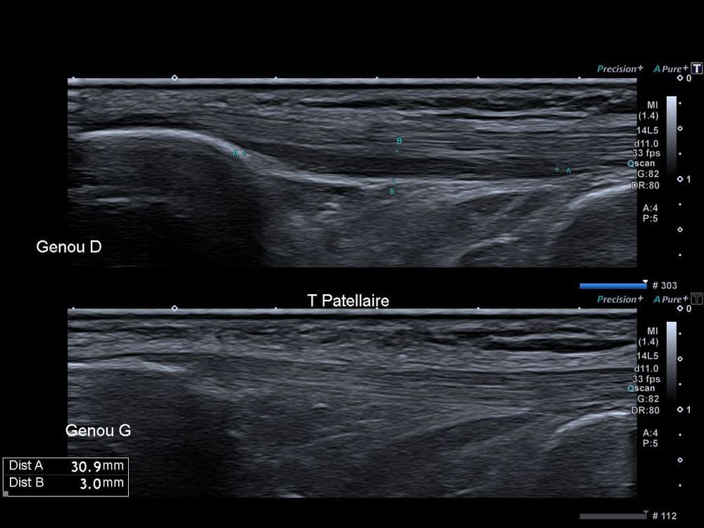 Tendinopathie patellaire corporéale profonde