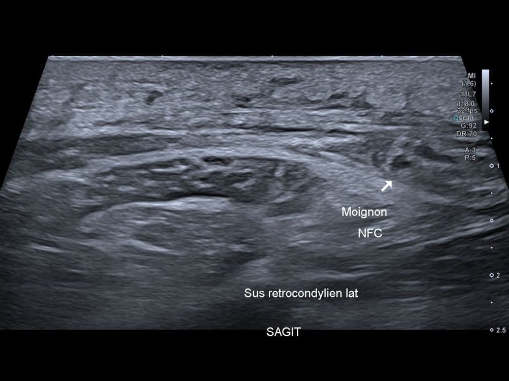 Rupture du nerf fibulaire commun sur traumatisme complexe du genou