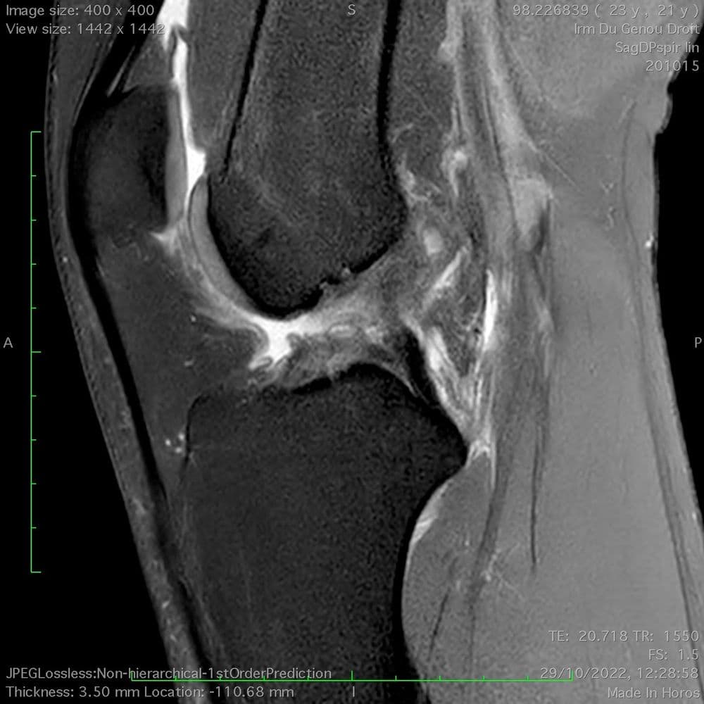 Lésions ménisco-ligamentaires multiples du genou (Triade)