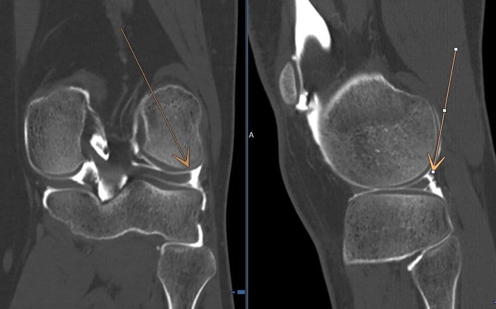 Désinsertion capsulo méniscale latérale