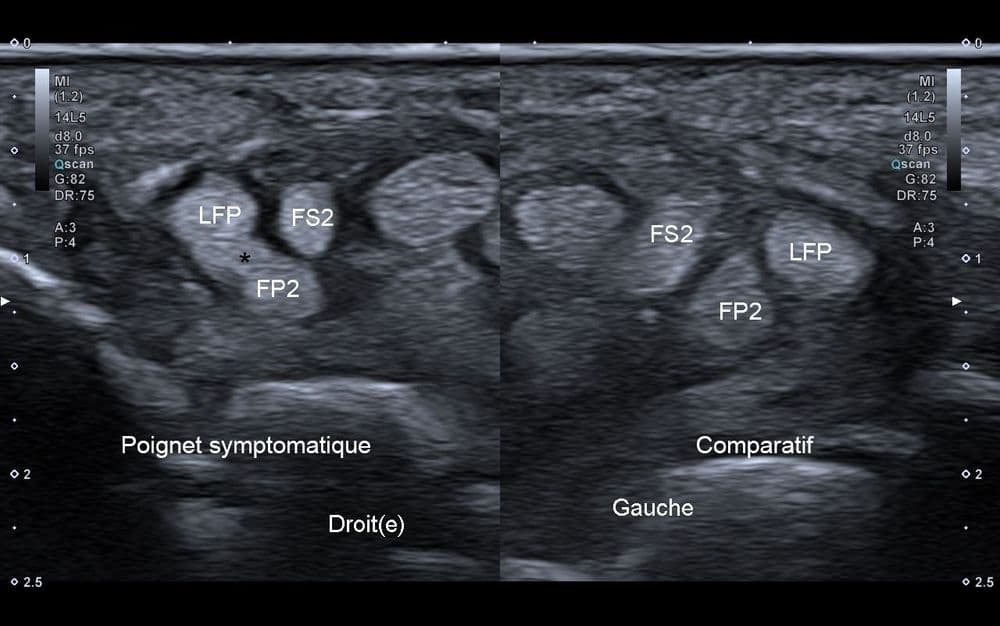 Syndrome de Linburg-Comstock