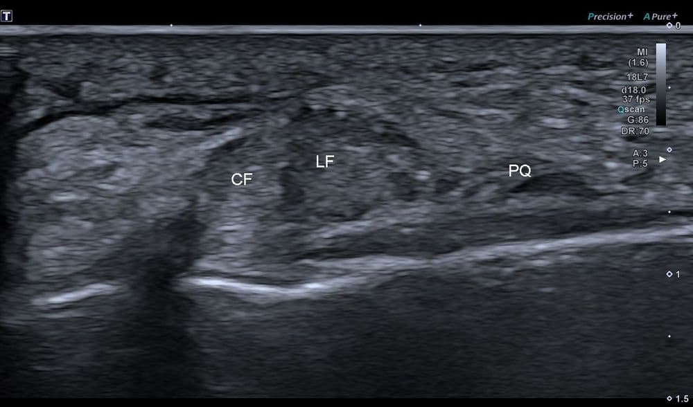 Tendon peroneus quartus
