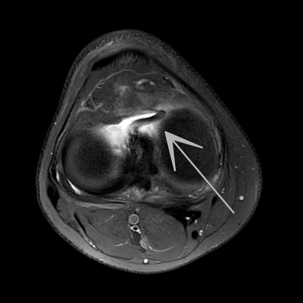 Languette méniscale instable