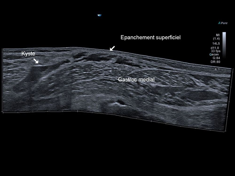 Rupture d'un kyste poplité
