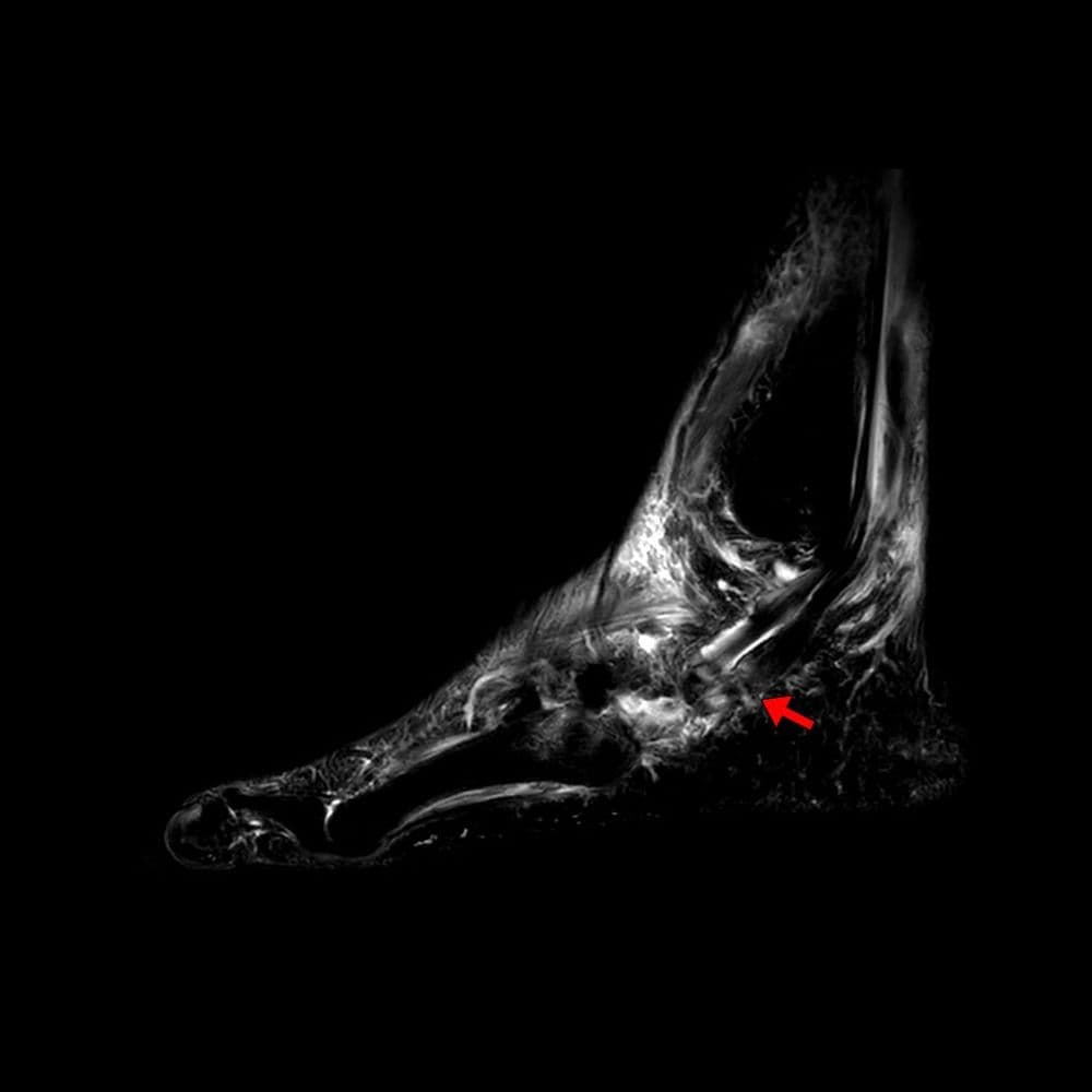 Rupture plantaire du tendon long fibulaire