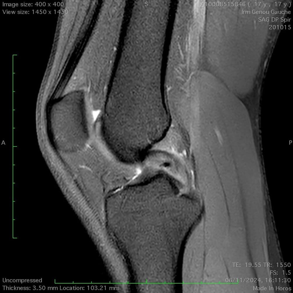 Rupture partielle du ligament croisé postérieur