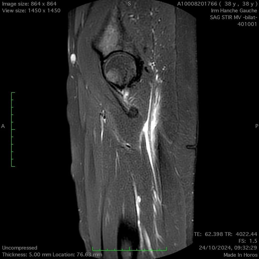 Lésion myotendineuse du grand adducteur