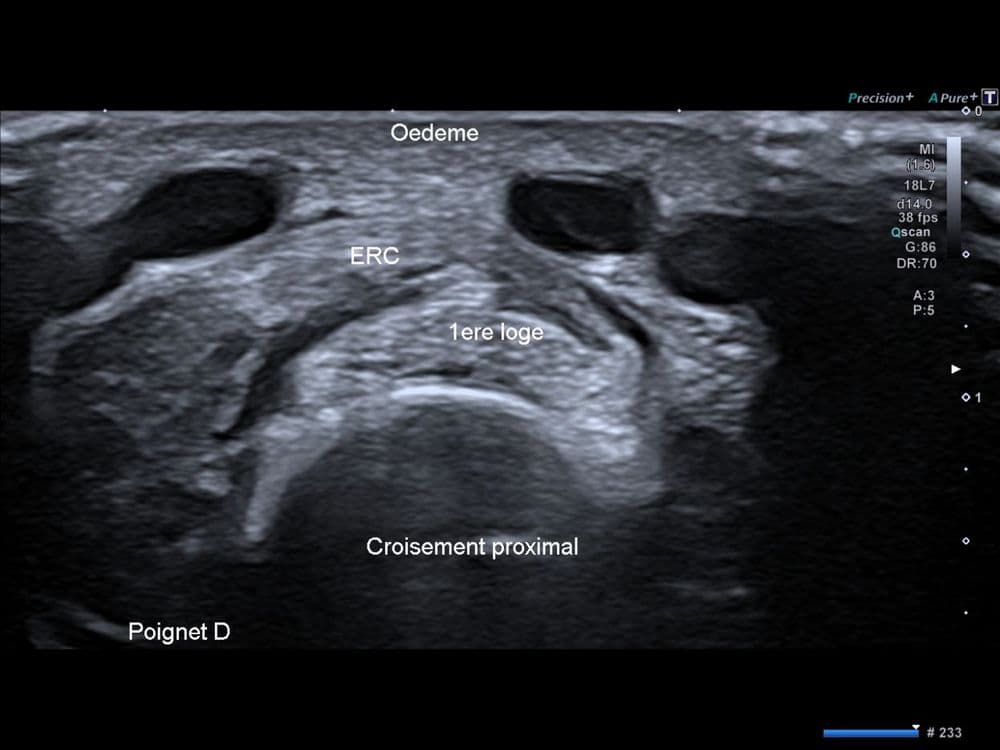 Syndrome du croisement proximal de l'avant-bras