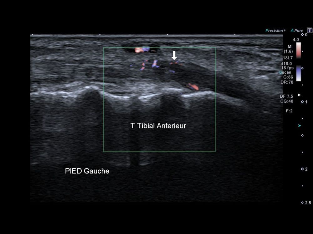Enthésopathie du tendon tibial anterieur