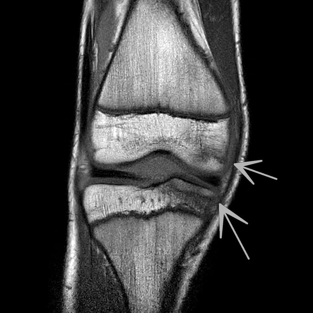 Contusion osteo-chondrale du genou