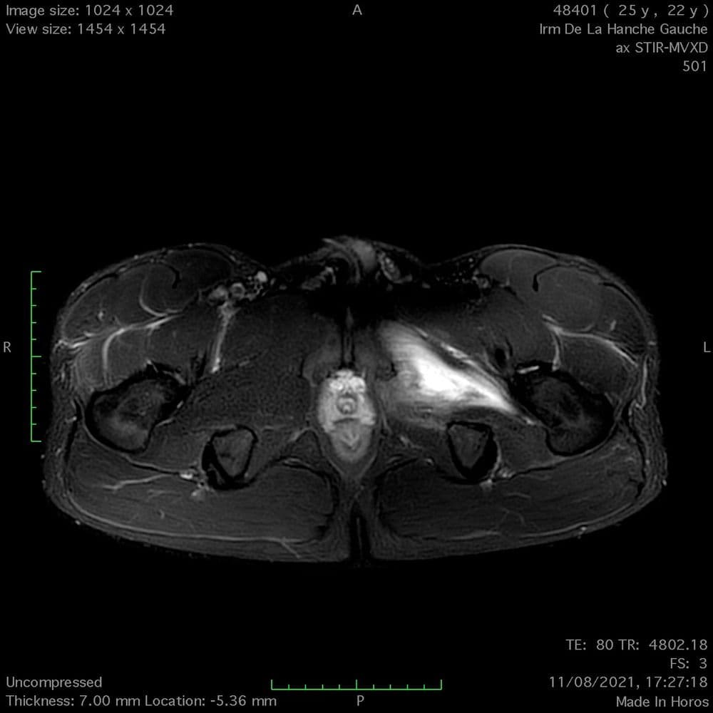 Lésion de l'obturateur externe de la hanche
