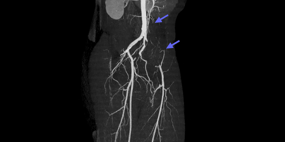 Endofibrose de l'artère iliaque externe