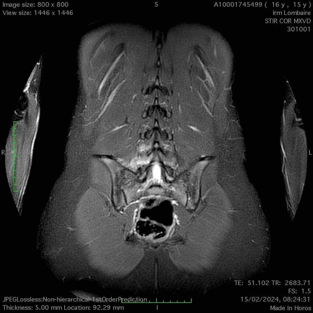 Lyse isthmique chez l'adolescent