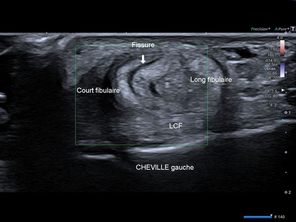 Tendinopathie du court fibulaire