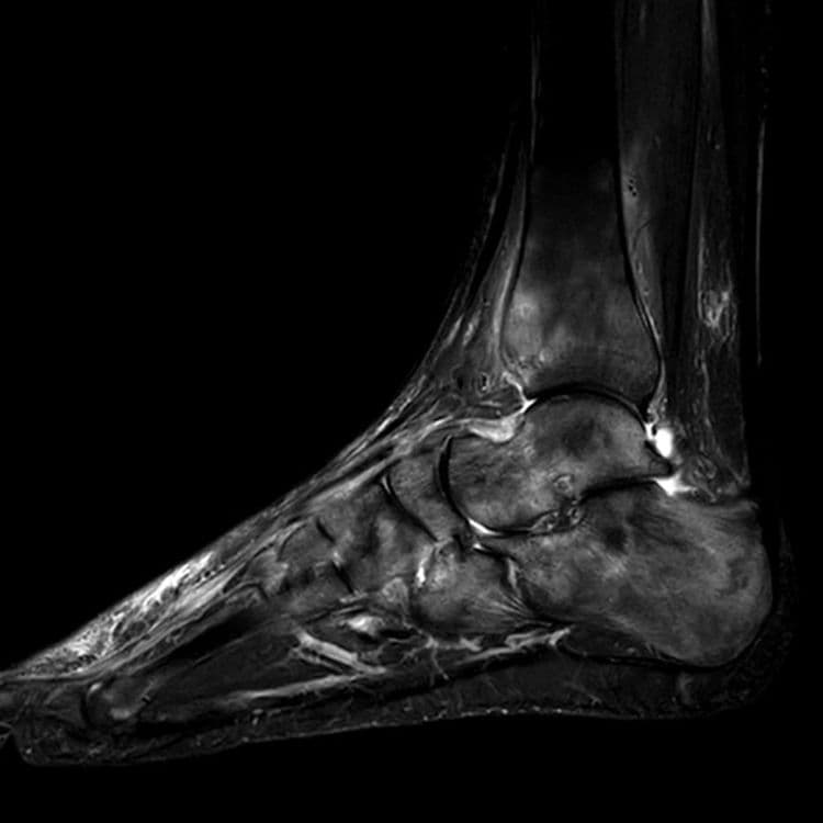 Algodystrophie de la cheville