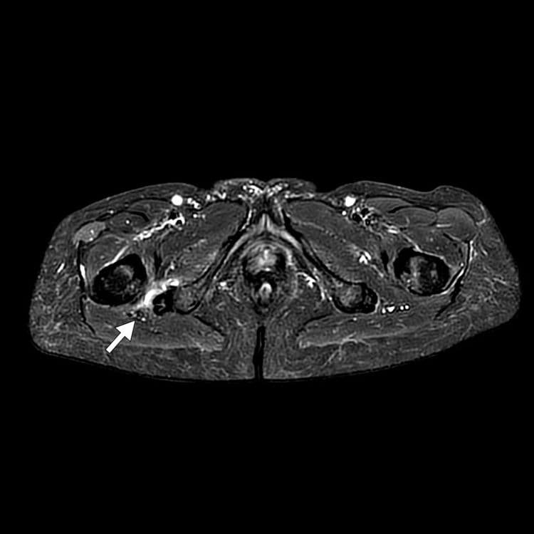 Conflit ischio-fémoral