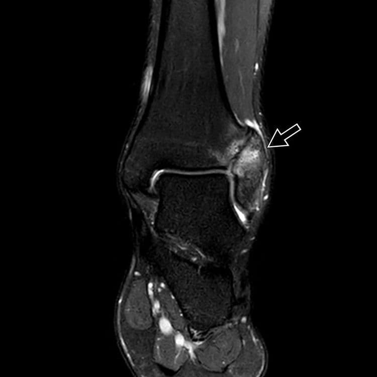 Pseudarthrose tibio-fibulaire inférieure
