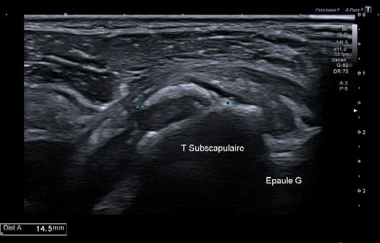 Résorption calcique aigue du tendon sous-scapulaire