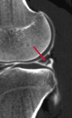 Apport de l'arthroscanner dans la recherche de fissure méniscale