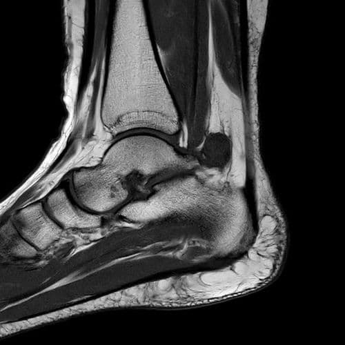 Synovite villonodulaire du carrefour postérieur