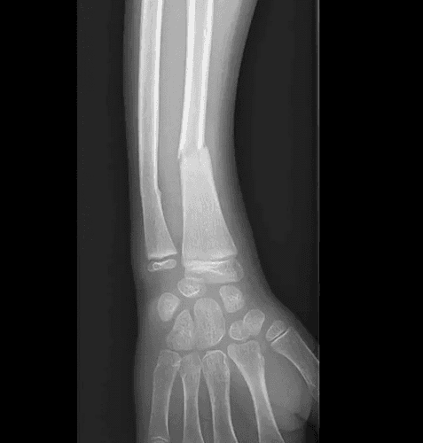Fracture du radius chez l'enfant