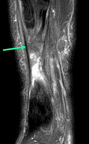 Rupture complète du tendon calcanéen